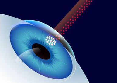 四种近视眼手术，哪种最靠谱?