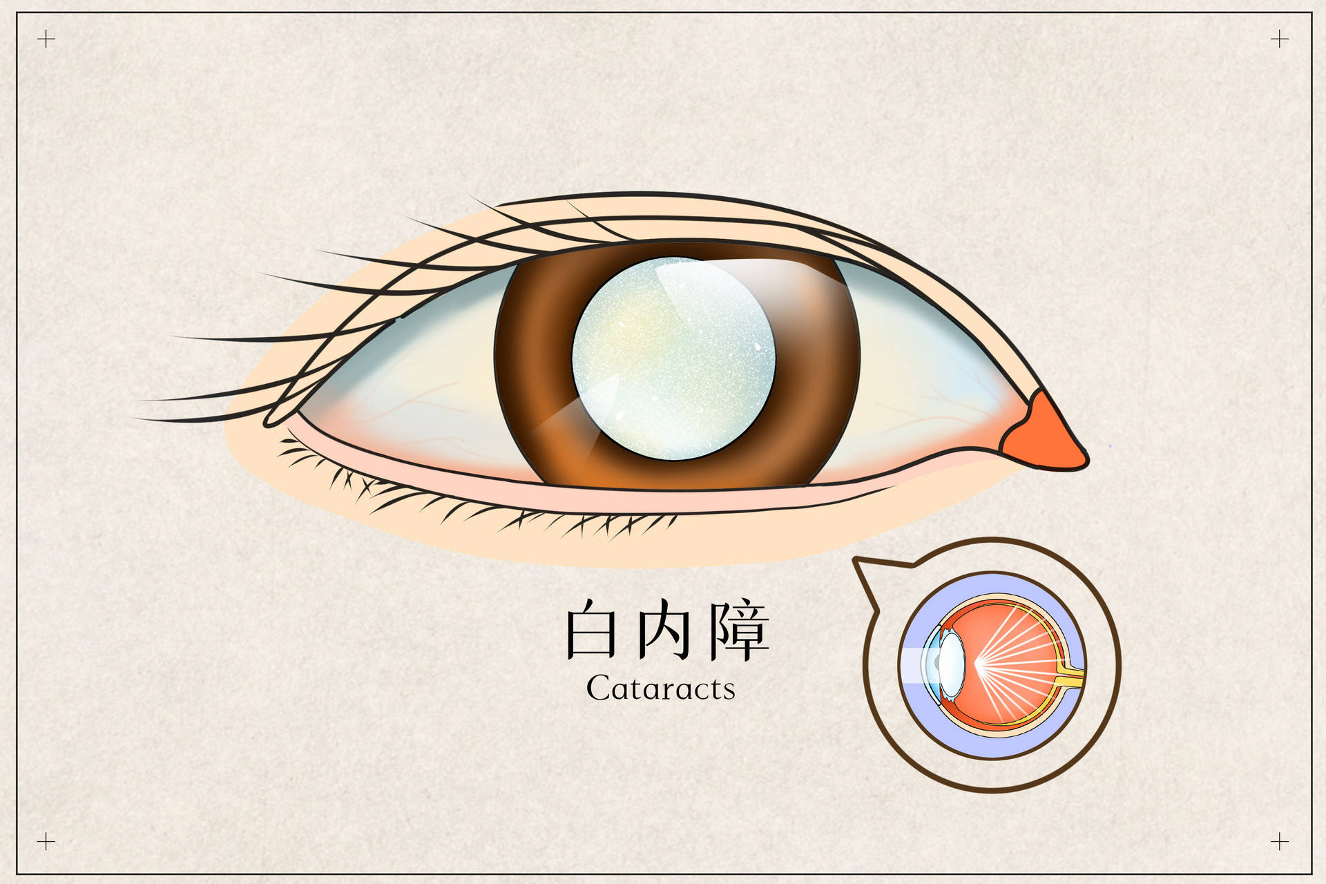 做过近视眼手术，还能做白内障手术吗？