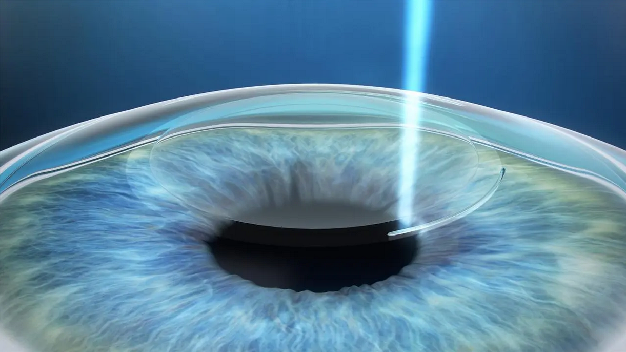 做了近视手术之后，近视还会遗传吗？