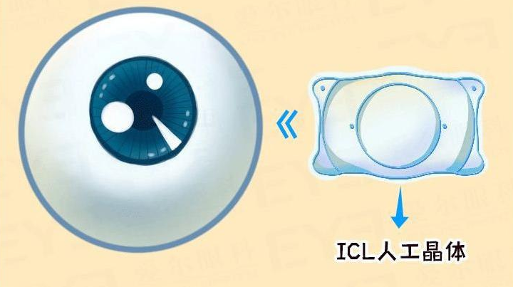 ICL 晶体近视手术的价格受哪些因素的影响？