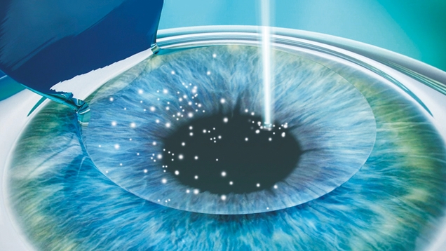 近视手术中常说的角膜瓣到底是什么？