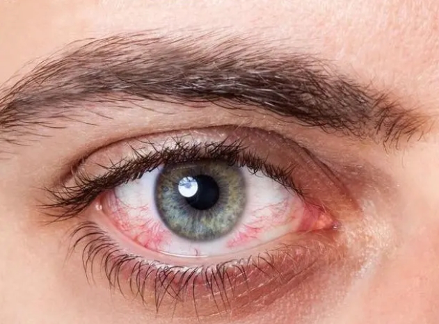 哪些原因会致使眼睛起血丝？