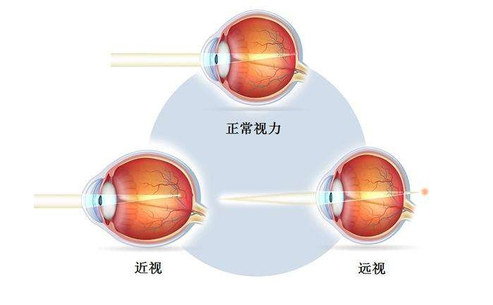 屈光不正可能引起哪些并发症？